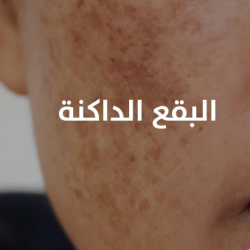 البقع الداكنة
