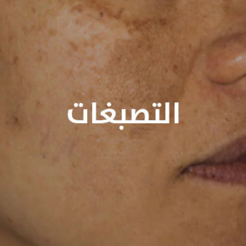 الكلف